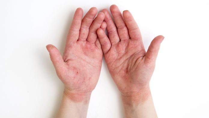 4 year old child red swollen cracked atopic dermatitis hands caused by lot of hand washing and hand sanitizing during covid-19 pandemic period in 2020. eczema symptoms