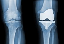 New pain management technique for knee replacement surgery