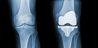 New pain management technique for knee replacement surgery