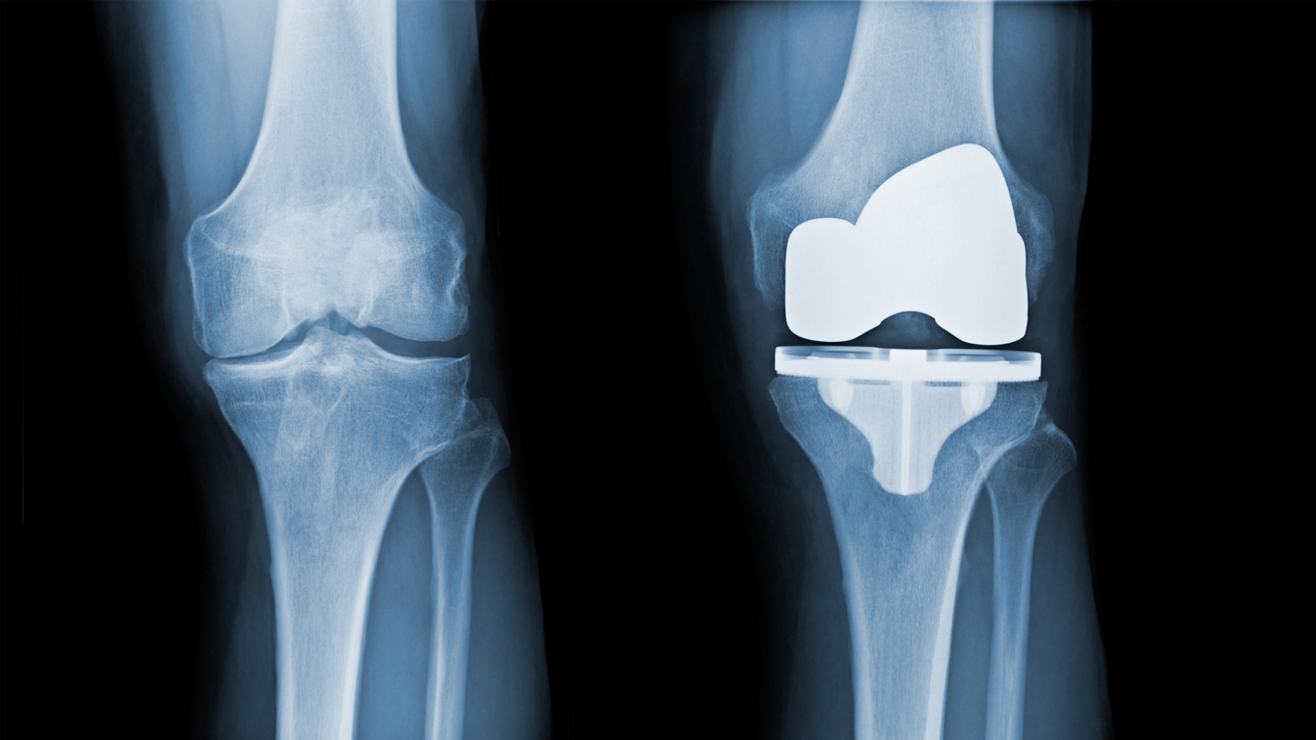 New pain management technique for knee replacement surgery