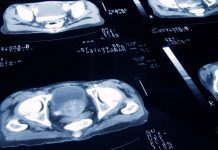 Portable prostate cancer test could provide effective early detection