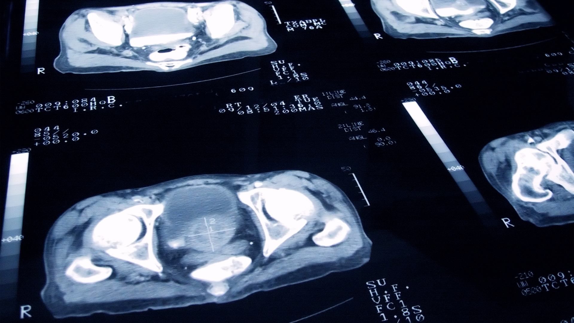 Portable prostate cancer test could provide effective early detection