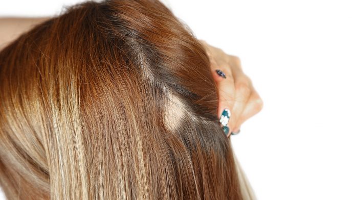 female pattern hair loss