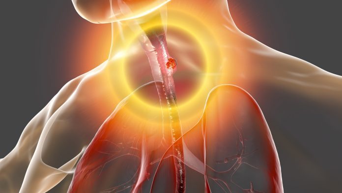 Esophageal cancer, illustration oesophageal cancer