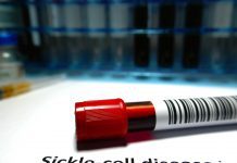 NHS treats first sickle cell disease patients with new drug