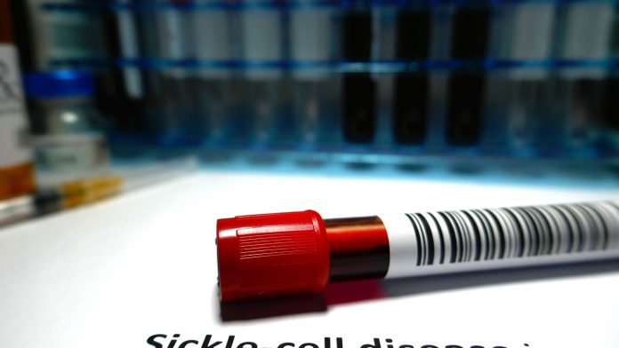 NHS treats first sickle cell disease patients with new drug