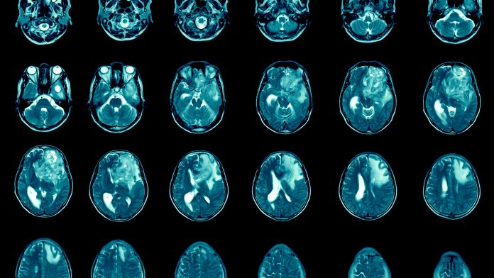 glioblastoma treatment