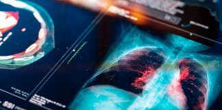 Small cell lung cancer discovery could lead to new treatment