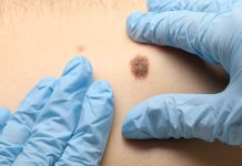 Healthy gut microbiome improves success of melanoma cancer treatment