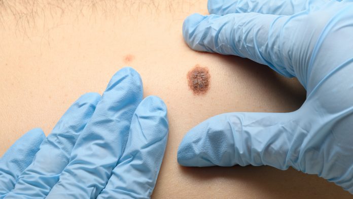 Healthy gut microbiome improves success of melanoma cancer treatment