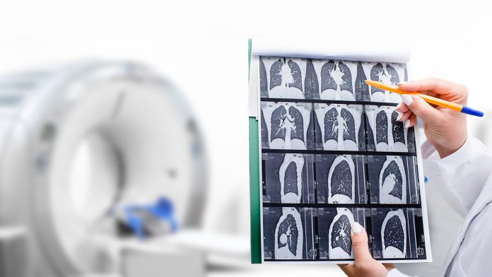 Radiologist showing tomography scan of a patient's lungs over of CT machine. Treatment of lung diseases, pneumonia, coronavirus, covid, cancer, tuberculosis lung cancer screening