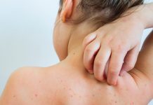 Chickenpox in children costs £24m in lost income and productivity in the UK