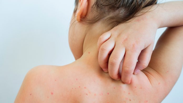 Chickenpox in children costs £24m in lost income and productivity in the UK