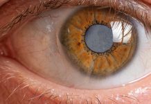World’s first drug treatment for cataracts could be available soon treatment for cataracts