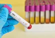 Vaccine for Epstein-Barr virus to undergo a clinical trial Epstein-Barr virus