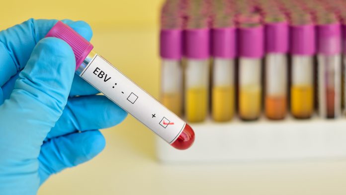 Epstein-Barr virus (EBV) Epstein-Barr virus