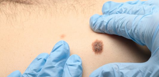 Revolutionary new technology for detecting skin cancer