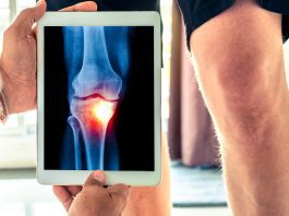Knee replacement surgery rates decreased following BMI policy introduction