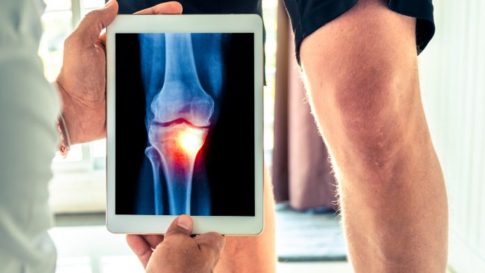 Knee replacement surgery rates decreased following BMI policy introduction