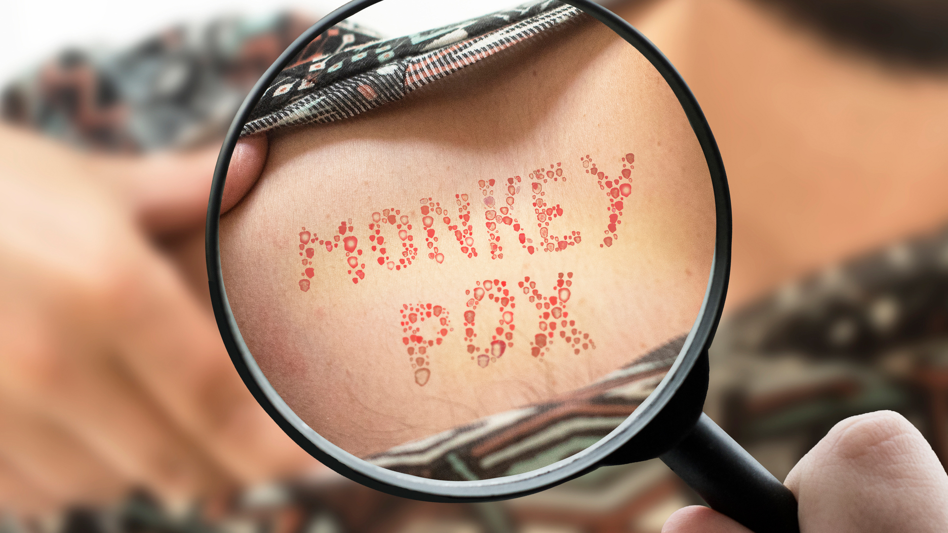 symptoms of monkeypox