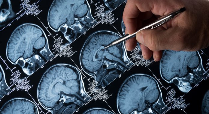 New AI algorithm could cure epileptic seizures 