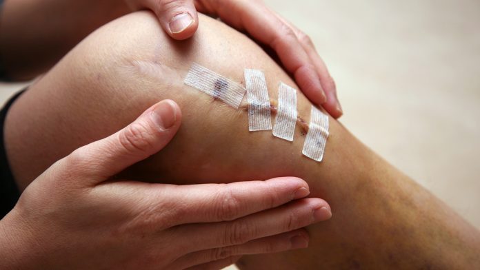 New method reduces pain after knee replacement surgery