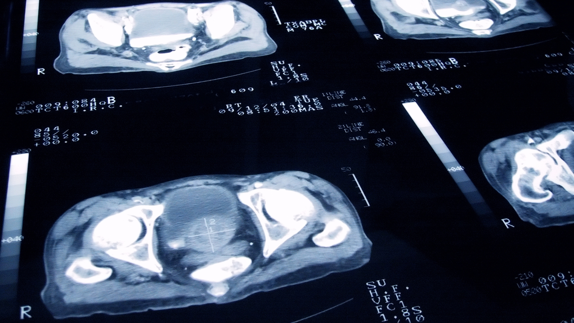 Considering genetic risk in patients could lead to earlier prostate cancer diagnosis