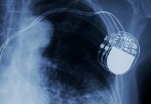 47% of parents experience PTSD after their child’s defibrillator implant 47% of parents experience PTSD after their child’s defibrillator implant