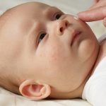Biomarker test predicts the development of eczema in babies 