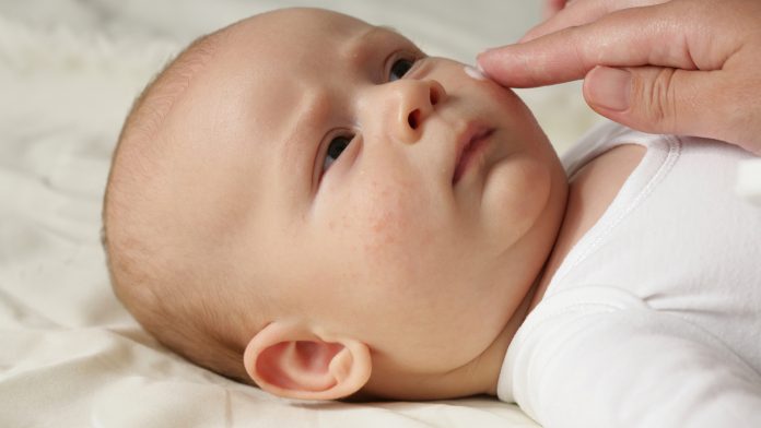 Biomarker test predicts the development of eczema in babies