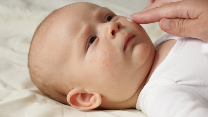 Biomarker test predicts the development of eczema in babies 