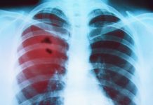 Invasive emphysema treatment may no longer be necessary