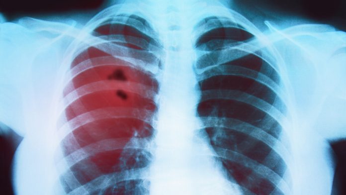 Invasive emphysema treatment may no longer be necessary
