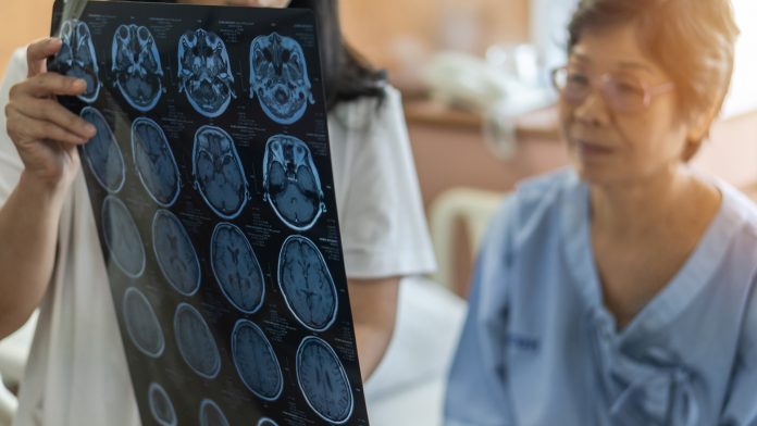 Signs of dementia can be identified nine years before diagnosis