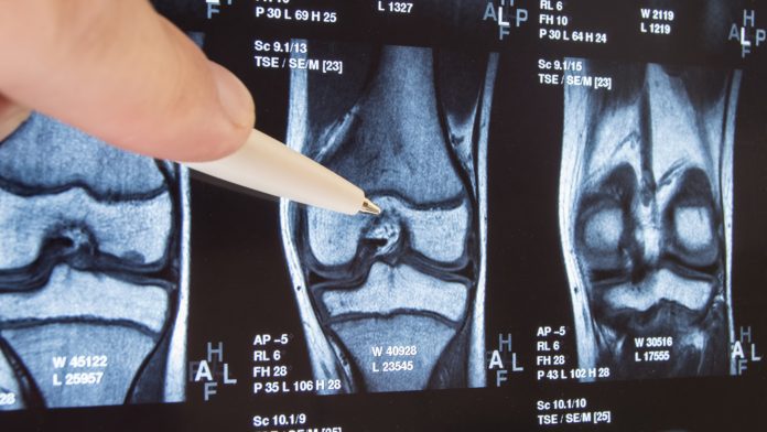 Harnessing generative design for knee implants