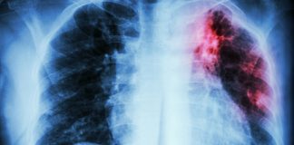 New tuberculosis treatment framework launched by WHO