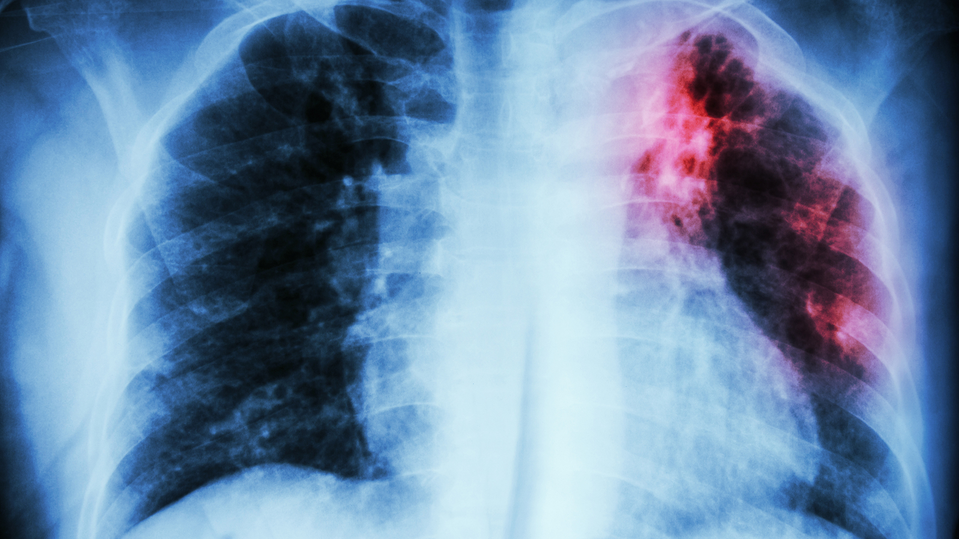 New tuberculosis treatment framework launched by WHO