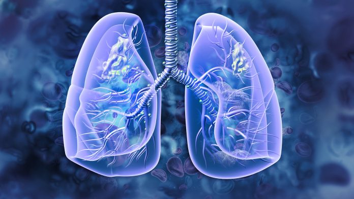 NICE approve mobocertinib to treat aggressive lung cancer