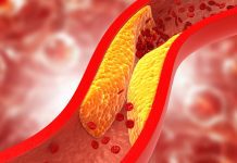 Atherosclerosis can be cured if it is spotted in early in life