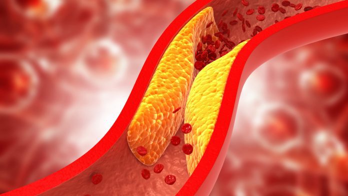 Atherosclerosis can be cured if it is spotted in early in life