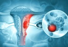 Researchers begin development of new endometrial cancer treatment