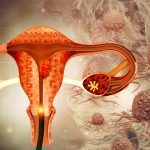 High-precision medicine can improve treatment for ovarian cancer