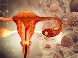 High-precision medicine can improve treatment for ovarian cancer