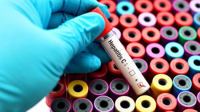 Non-invasive tests work in long-term hepatitis C treatment