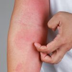 How understanding skin inflammation can combat UV damage