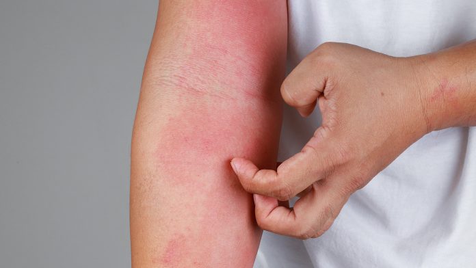 How understanding skin inflammation can combat UV damage