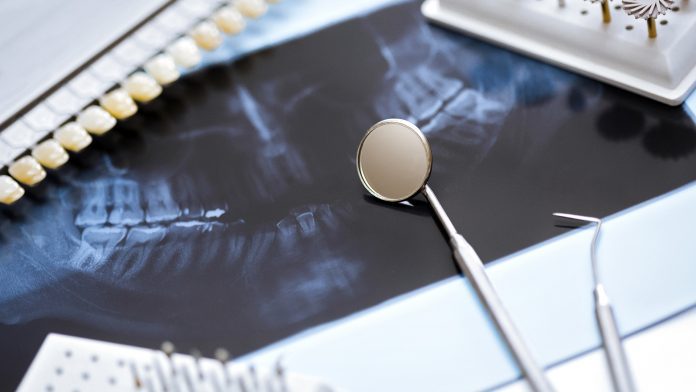 Understanding the link between IBD and periodontal disease