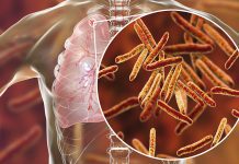 WHO publish updated guidelines on drug-resistant TB treatment