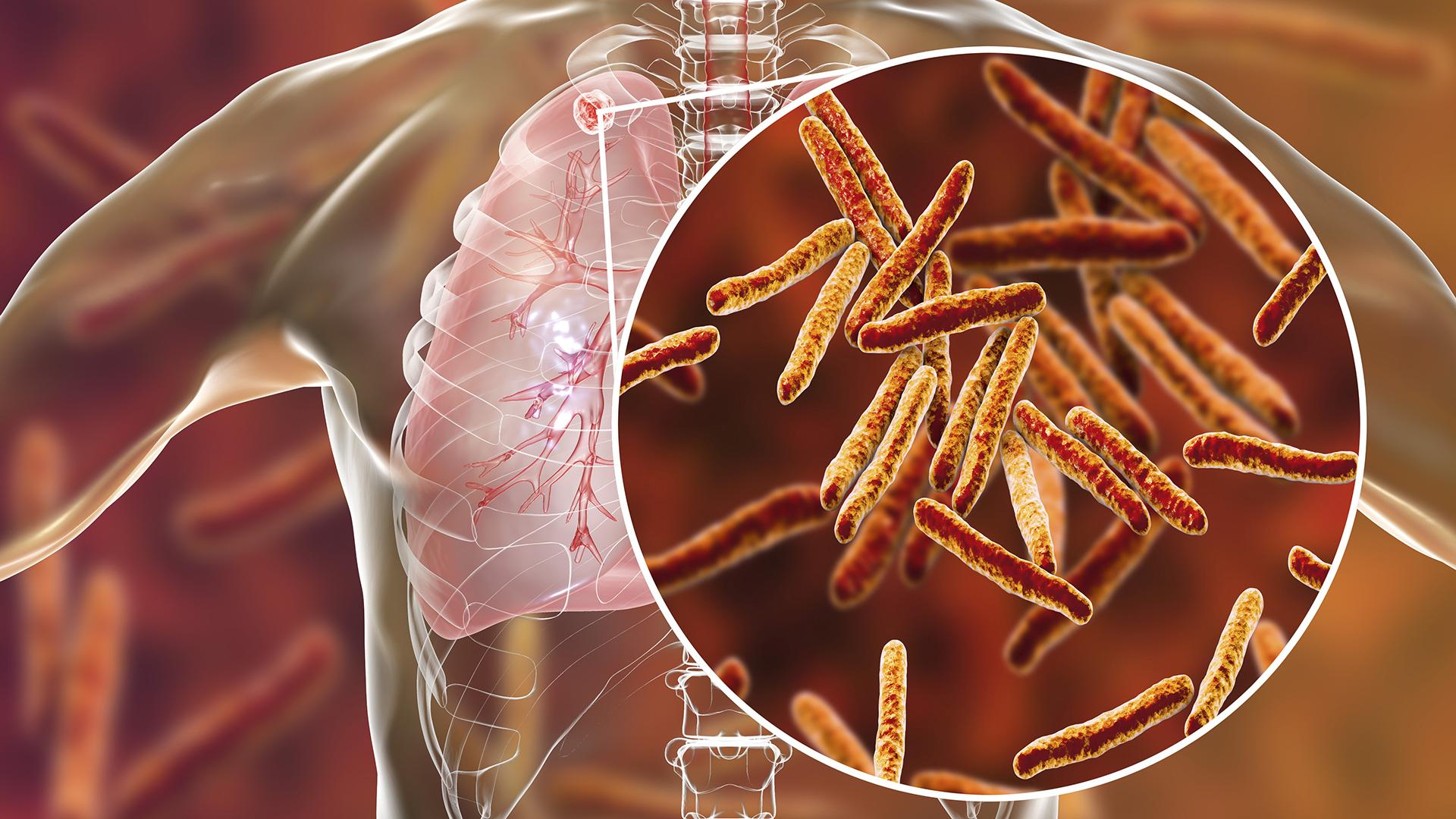 WHO publish updated guidelines on drug-resistant TB treatment