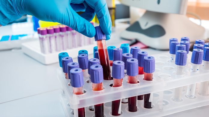 Urgent need for revised chronic hepatitis B guidelines in Africa